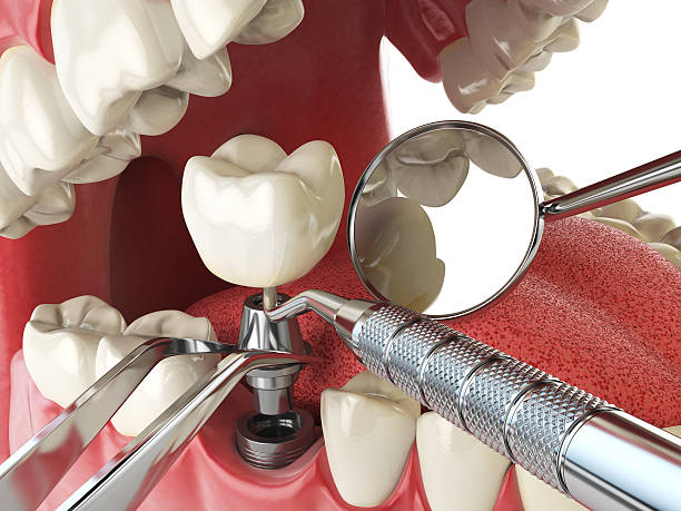 Best Emergency Root Canal Treatment in Sandy Springs, SC